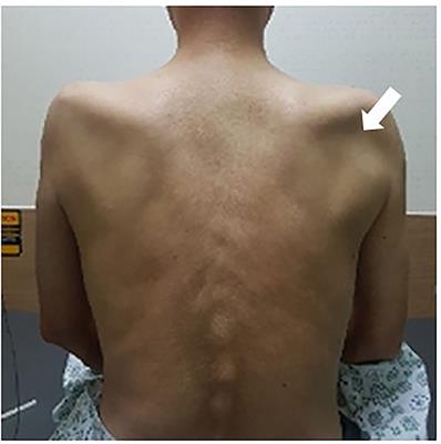 Posterior Interosseous Fascicular Constriction Within the Radial Nerve in a Diabetic Patient With Bilateral Neuralgic Amyotrophy: A Case Report